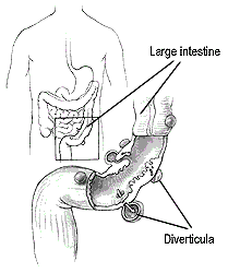 photo of Diverticulitis