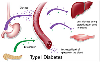 Natural Remedies for Type I Diabetes